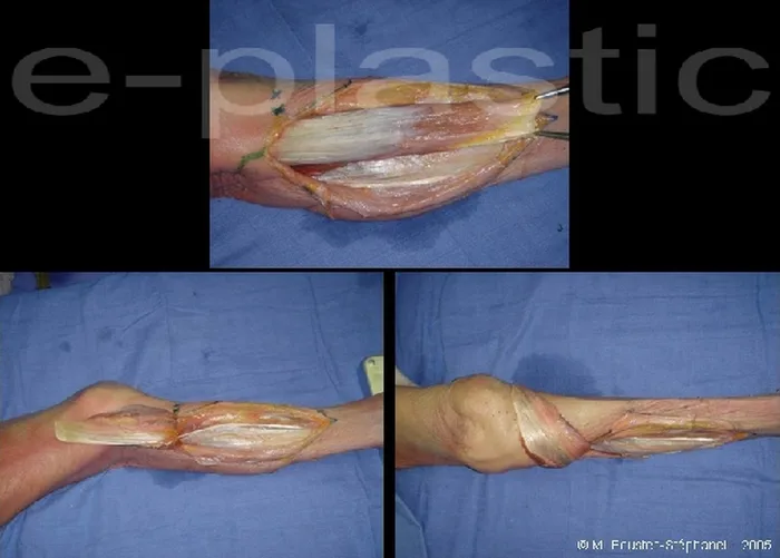 Lambeau de muscle gastrocnémien médial — figure 14