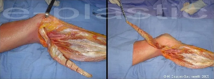 Lambeau de muscle gastrocnémien médial — figure 16