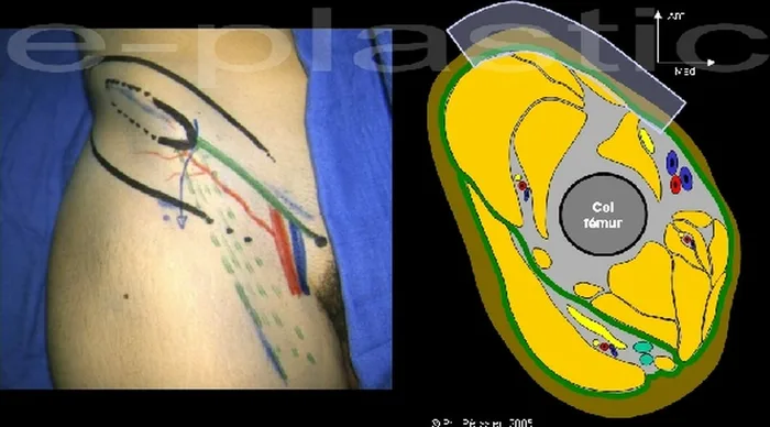 Lambeau inguinal cutané — figure 1