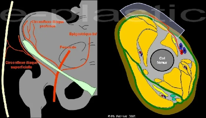 Lambeau inguinal cutané — figure 3