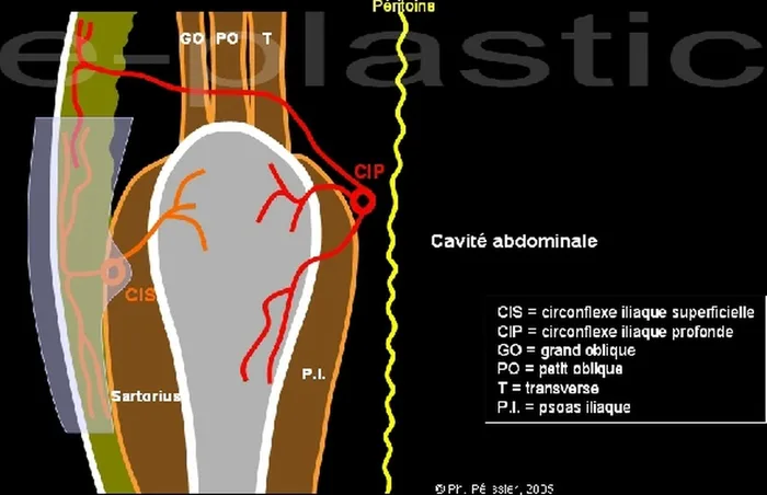Lambeau inguinal cutané — figure 4