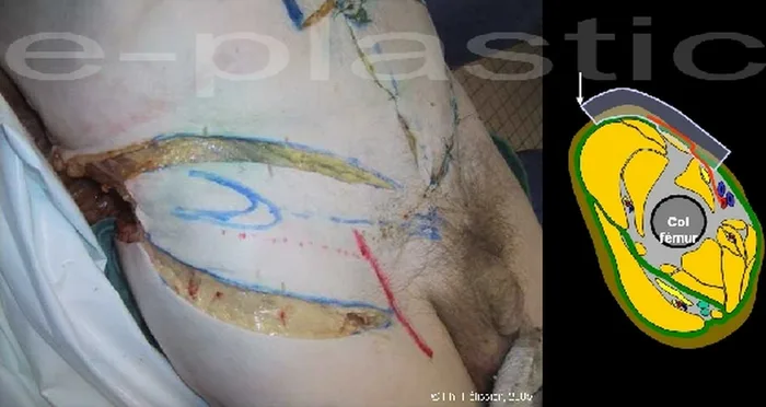 Lambeau inguinal cutané — figure 6