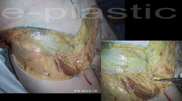Lambeau inguinal cutané — figure 9
