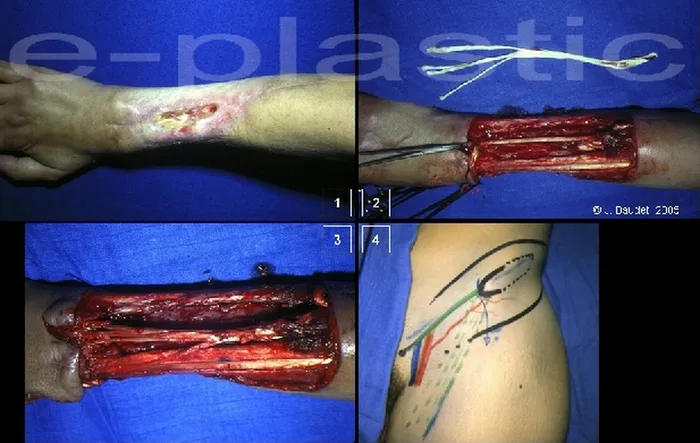 Lambeau inguinal cutané — figure 10