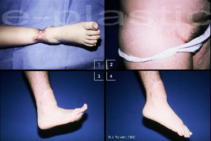 Lambeau inguinal cutané — figure 12