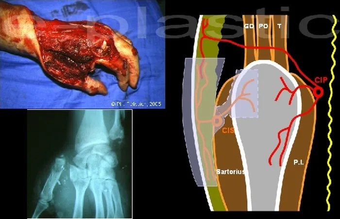 Lambeau inguinal cutané — figure 13