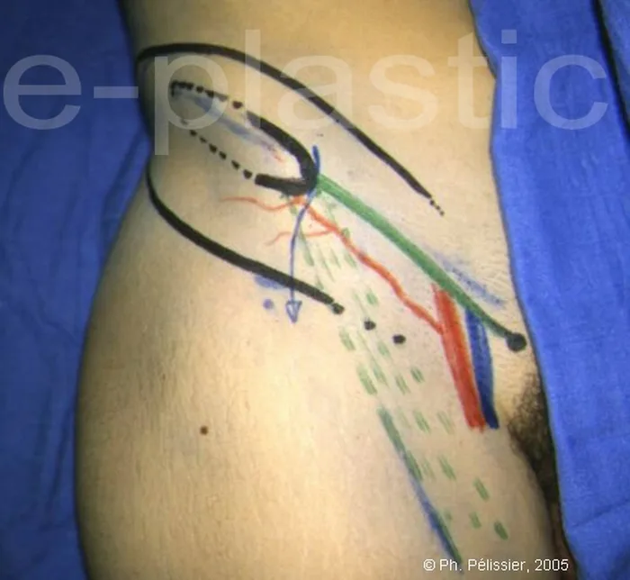 Lambeau inguinal ostéo-cutané — figure 1