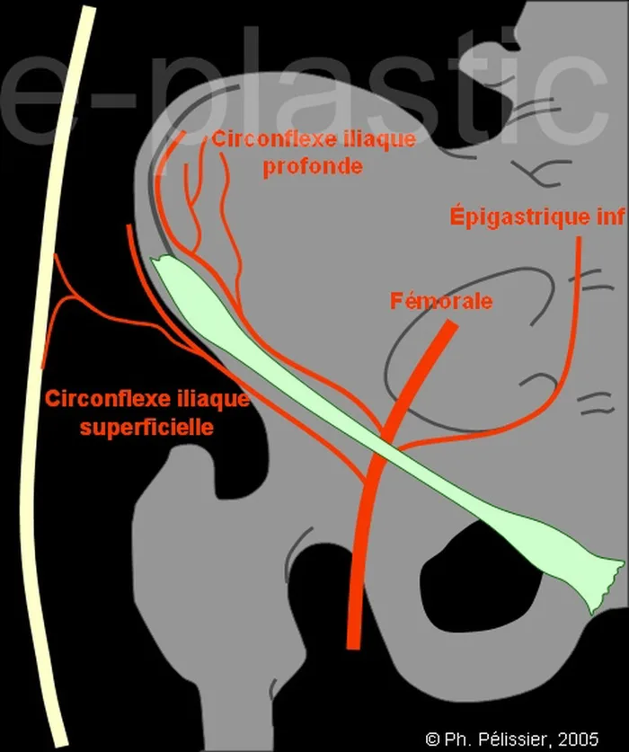 Lambeau inguinal ostéo-cutané — figure 2