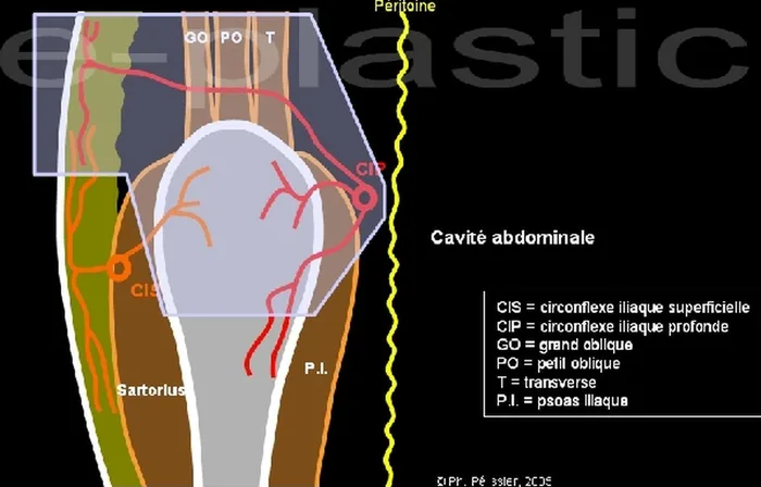 Lambeau inguinal ostéo-cutané — figure 3