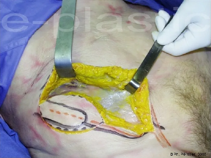 Lambeau inguinal ostéo-cutané — figure 4