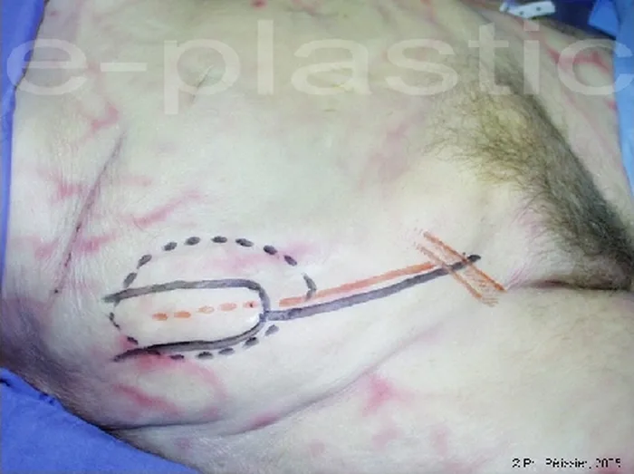 Lambeau inguinal ostéo-cutané — figure 5