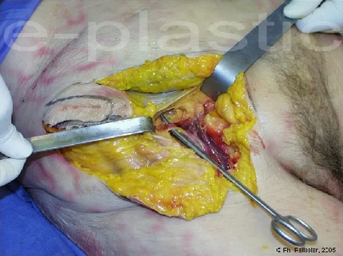 Lambeau inguinal ostéo-cutané — figure 6