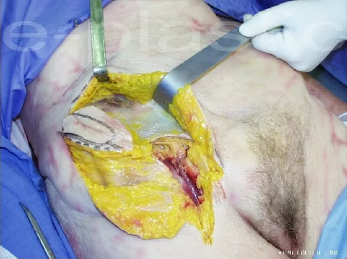 Lambeau inguinal ostéo-cutané — figure 7