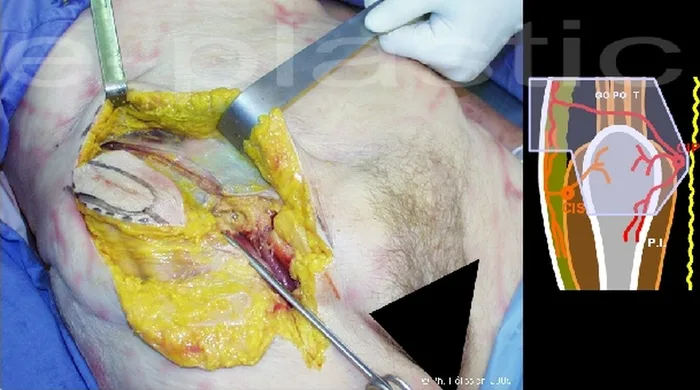 Lambeau inguinal ostéo-cutané — figure 9