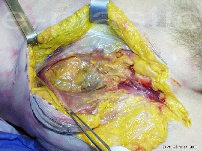 Lambeau inguinal ostéo-cutané — figure 10
