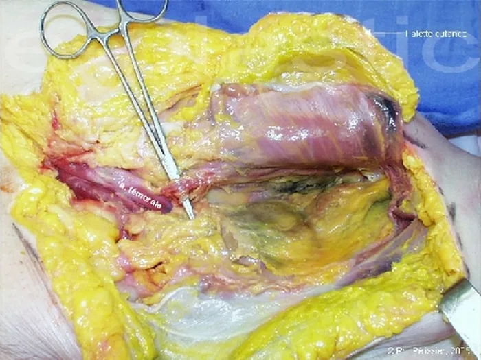 Lambeau inguinal ostéo-cutané — figure 11