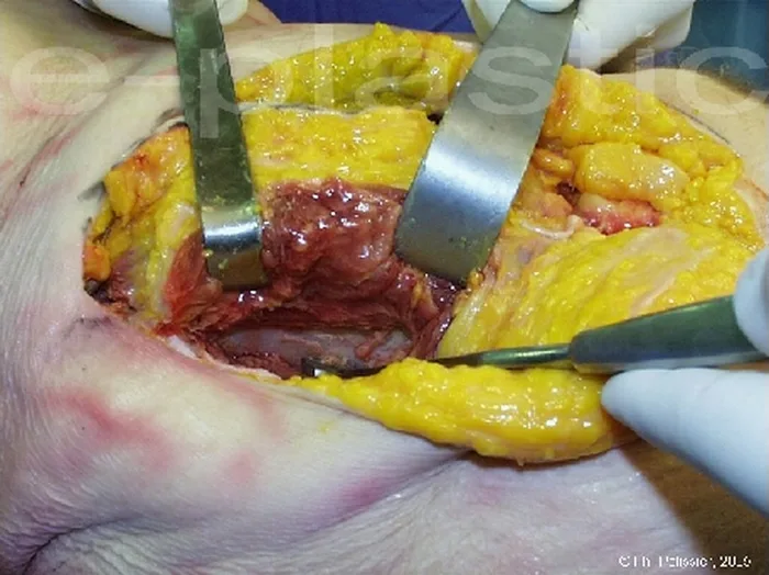 Lambeau inguinal ostéo-cutané — figure 12