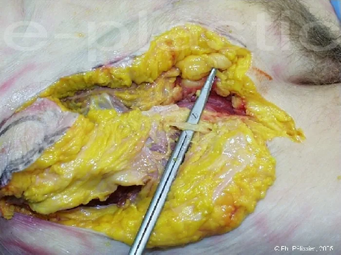 Lambeau inguinal ostéo-cutané — figure 13