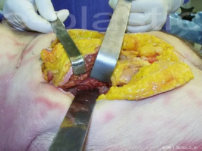 Lambeau inguinal ostéo-cutané — figure 14