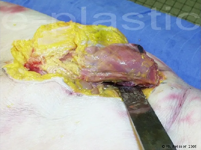 Lambeau inguinal ostéo-cutané — figure 15