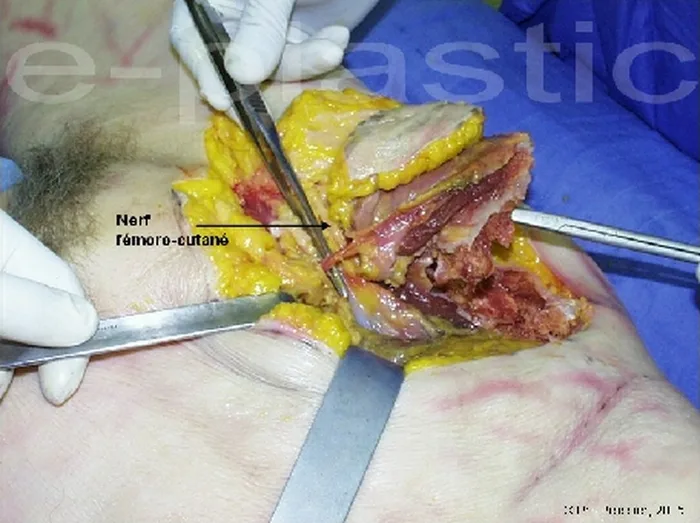 Lambeau inguinal ostéo-cutané — figure 16