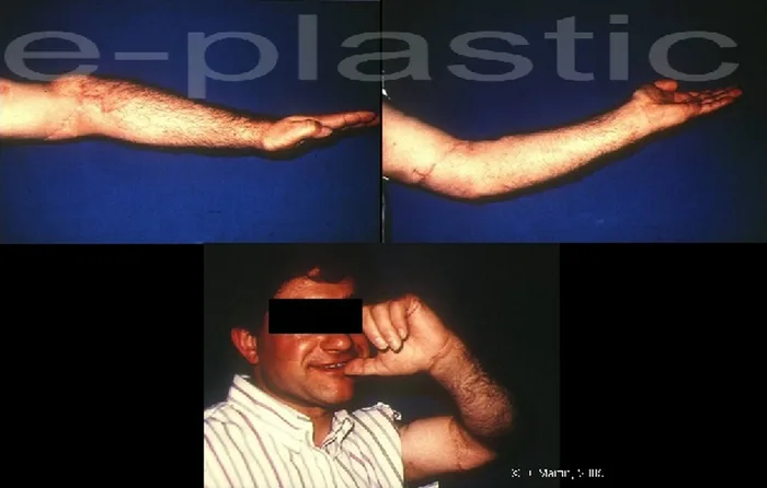 Lambeau inguinal ostéo-cutané — figure 18