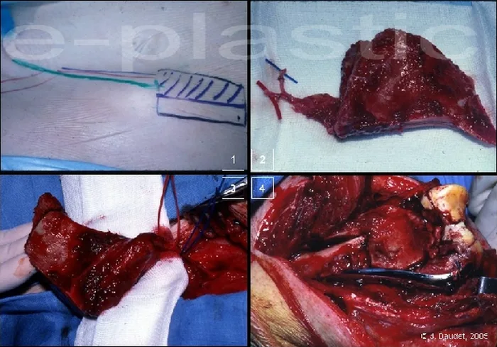Lambeau inguinal ostéo-cutané — figure 19