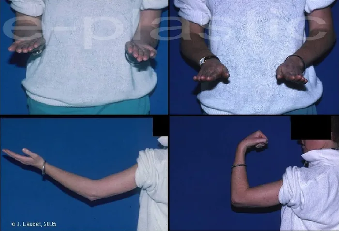 Lambeau inguinal ostéo-cutané — figure 22