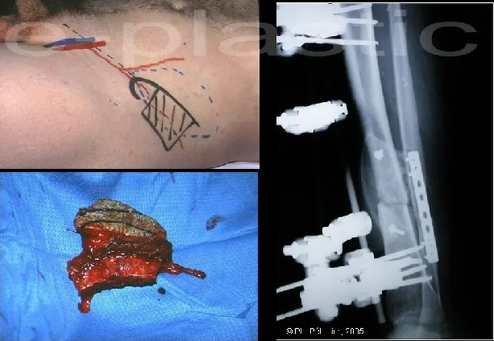 Lambeau inguinal ostéo-cutané — figure 26