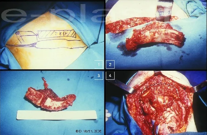 Lambeau inguinal ostéo-cutané — figure 27