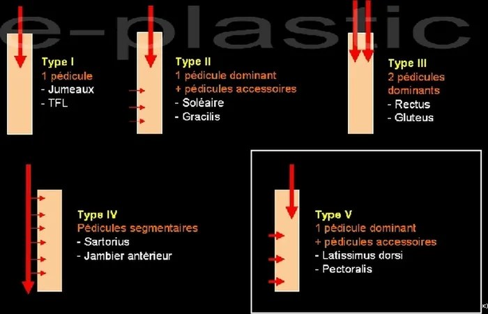 Lambeau de latissimus dorsi — figure 4