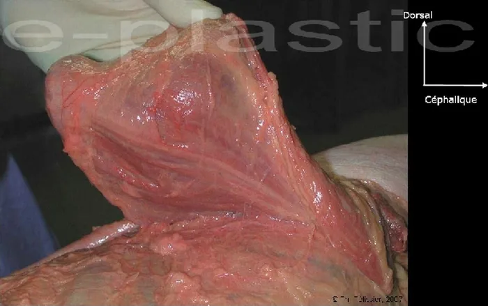 Lambeau de latissimus dorsi — figure 5