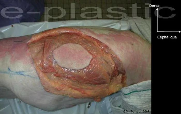 Lambeau de latissimus dorsi — figure 6