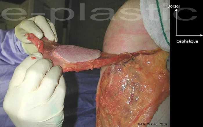 Lambeau de latissimus dorsi — figure 7
