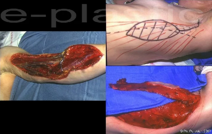 Lambeau de latissimus dorsi — figure 9
