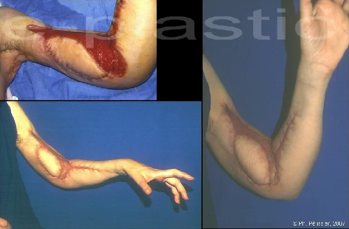 Lambeau de latissimus dorsi — figure 10