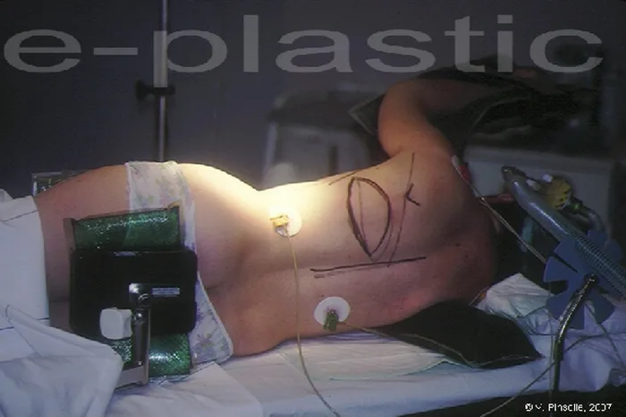 Lambeau de latissimus dorsi — figure 12