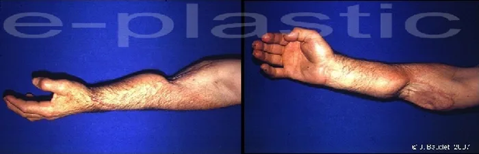Lambeau de latissimus dorsi — figure 13