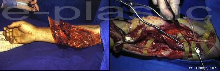 Lambeau de latissimus dorsi — figure 14