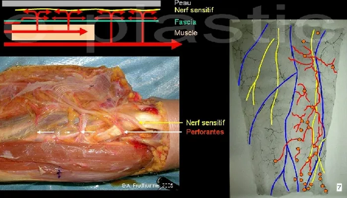 Lambeau neuro-cutané sural — figure 1