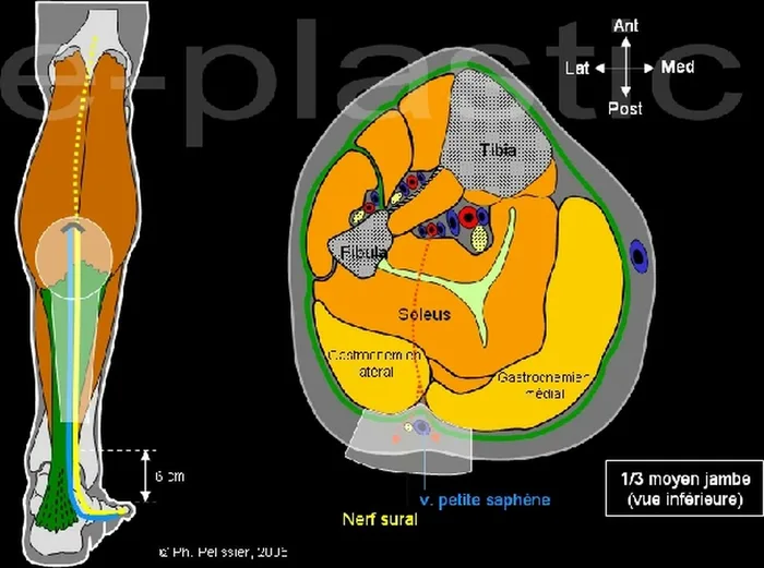 Lambeau neuro-cutané sural — figure 2