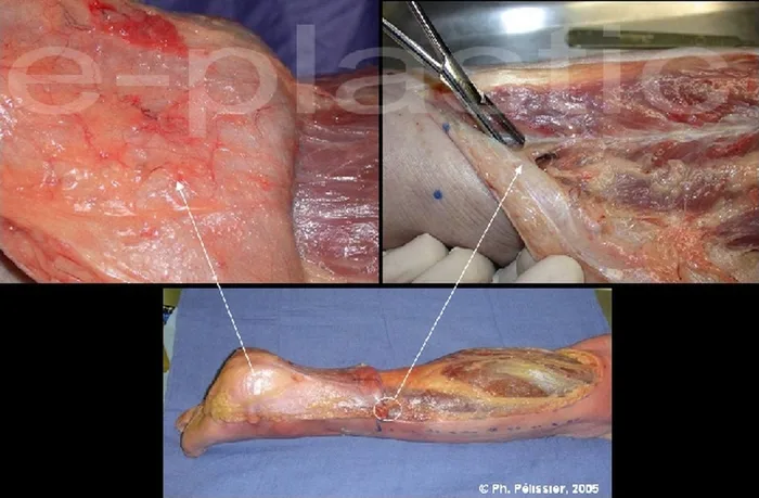 Lambeau neuro-cutané sural — figure 3