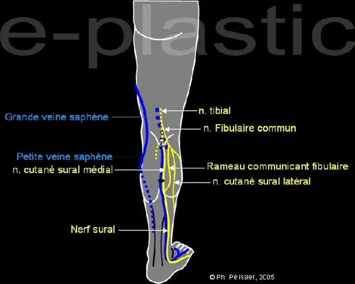 Lambeau neuro-cutané sural — figure 4