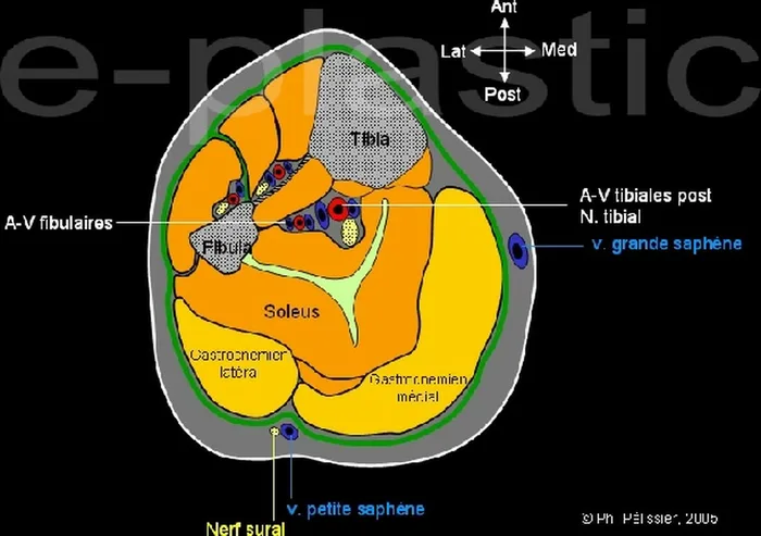 Lambeau neuro-cutané sural — figure 5