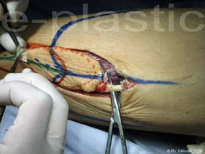 Lambeau neuro-cutané sural — figure 6