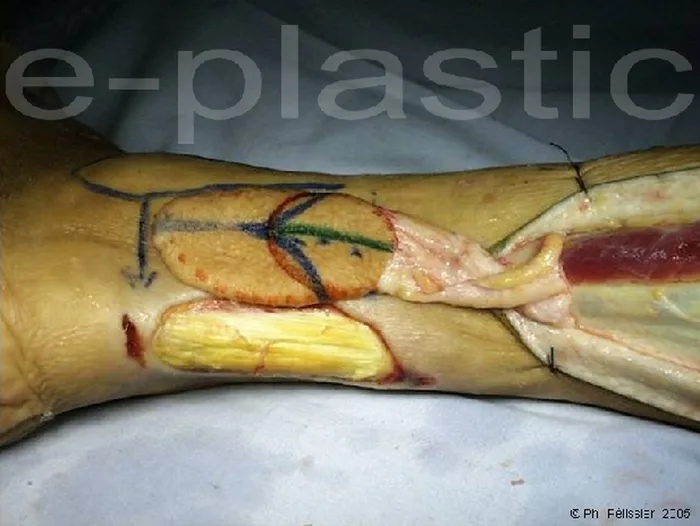 Lambeau neuro-cutané sural — figure 11
