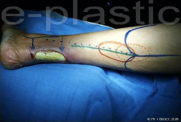 Lambeau neuro-cutané sural — figure 12