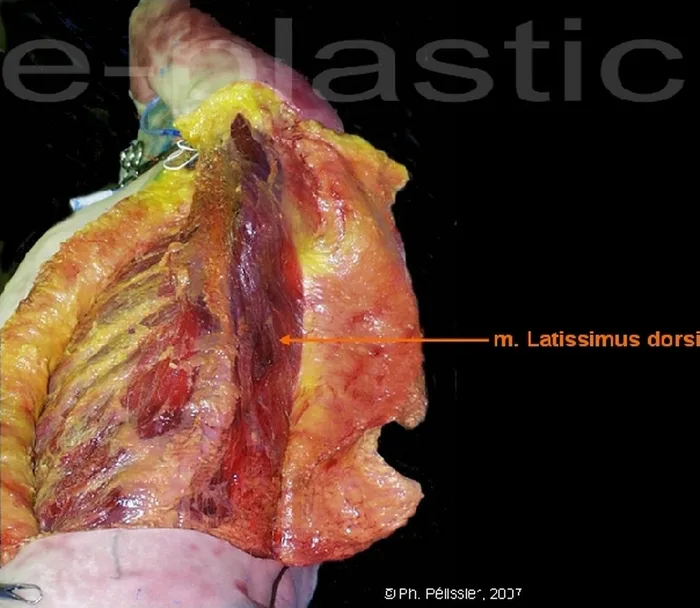 Lambeau parascapulaire — figure 5