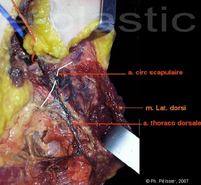Lambeau parascapulaire — figure 6