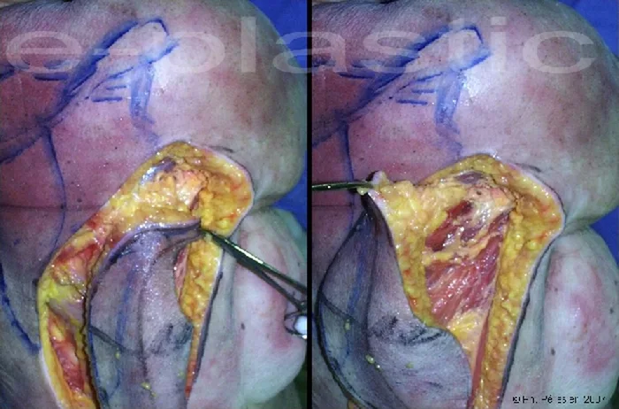 Lambeau parascapulaire — figure 9
